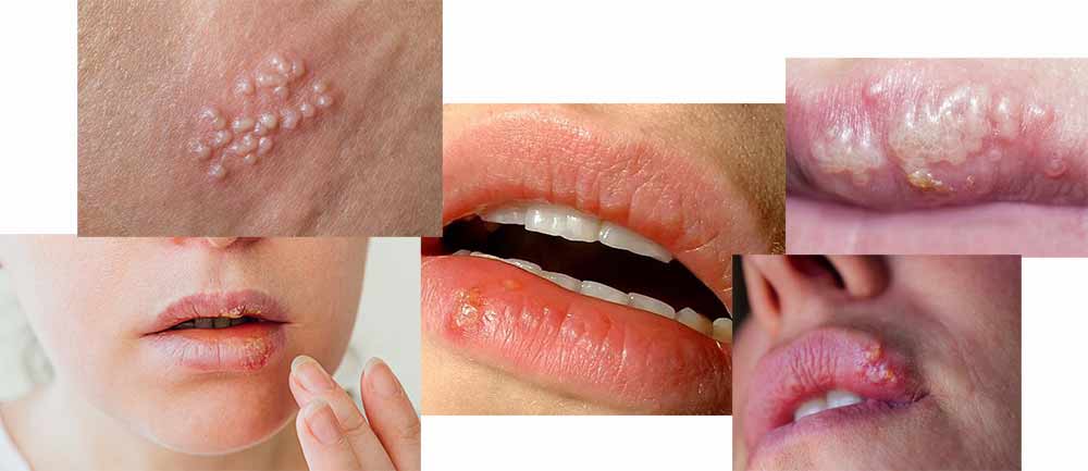 herpes-slika